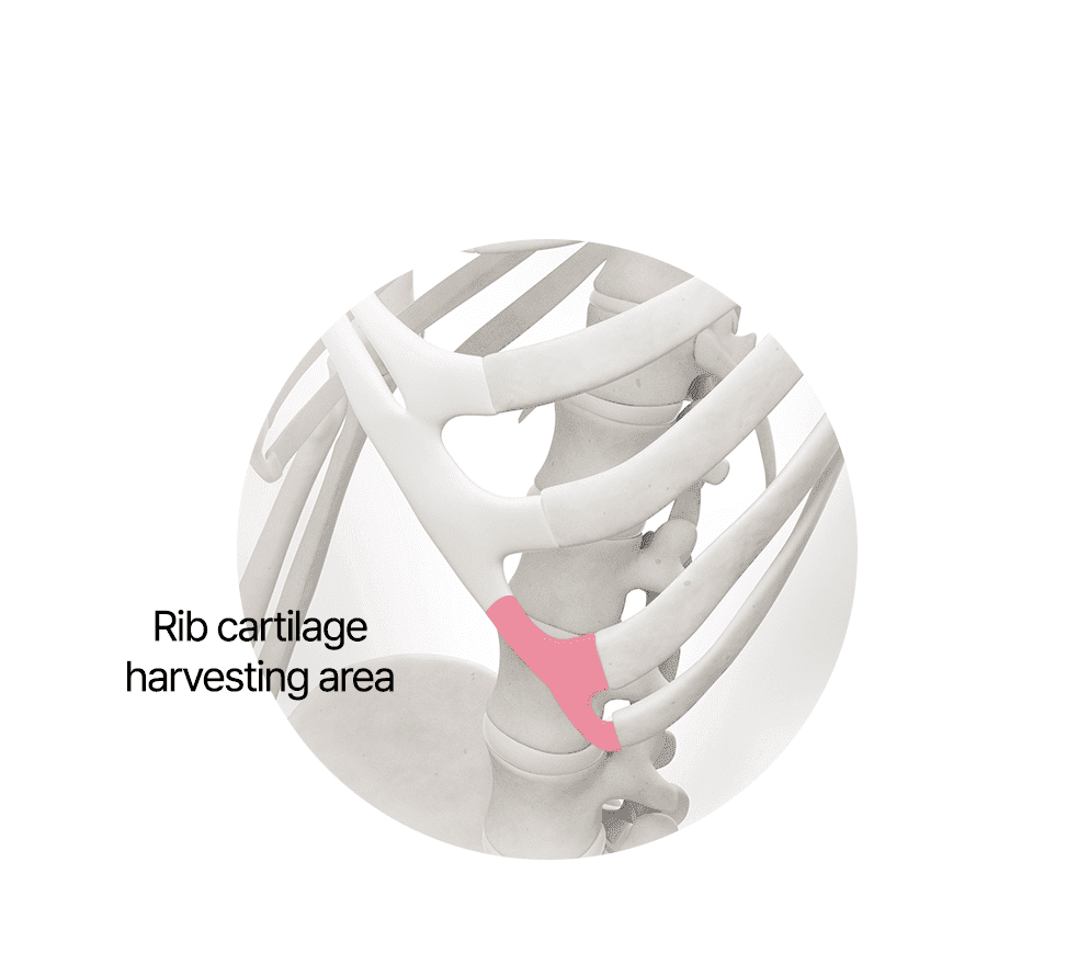 Harvesting Rib Cartilage