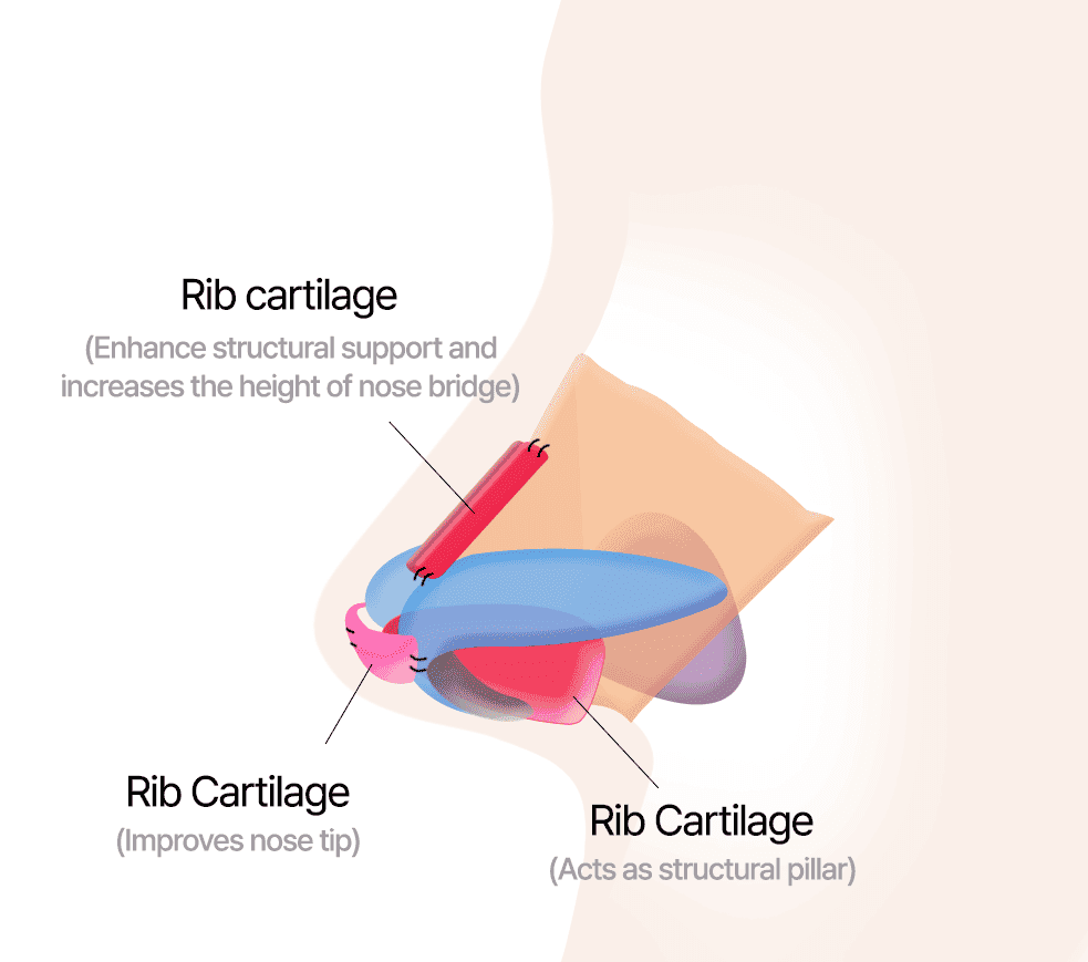 Correction Using Rib Cartilage