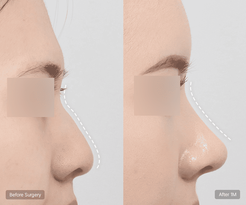 Implant-free Rhinoplasty