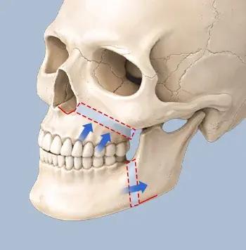Orthognathic Surgery