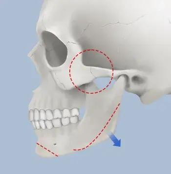 Facial Contouring Surgery