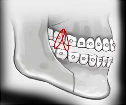 3. Stable Results with Simple Band Fixation