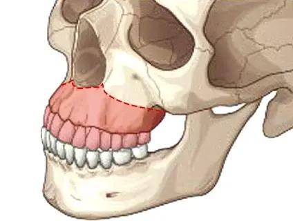 Maxillary surgery