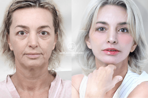 Plastic Surgery in Korea for Foreigners: Essential FAQs (2026) | AB Plastic Surgery