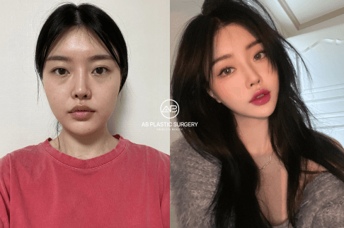 Top 8 Wide Face Surgery: How to Achieve Narrower and Smaller Face