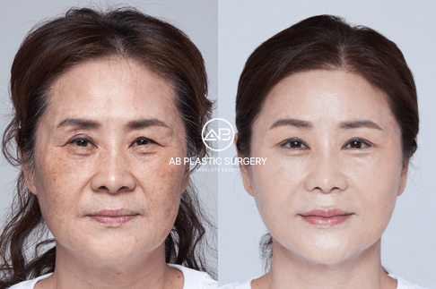 Thermage for Eyes: The Best Treatment for Eye Wrinkles & Sagging?