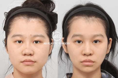 Facial Contouring Gone Wrong? How to Avoid Botched Results and Get a Perfect Look in Korea