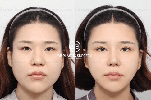 Why 87% of V-line Patients Choose Korea: Methods Only Available in Korea