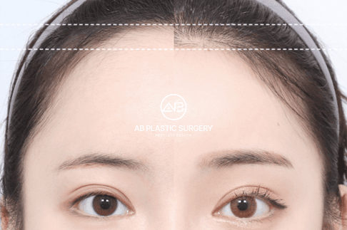 7 Reasons Why Korea Leads the World in Forehead Reduction Surgery