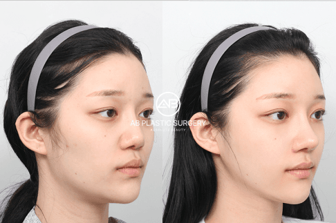First-Timer's Guide: What to Expect When Getting Plastic Surgery in Seoul