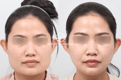 Jawline Surgery in Korea: Types, Cost, Recovery & V-Line Results (2026) | AB Plastic Surgery