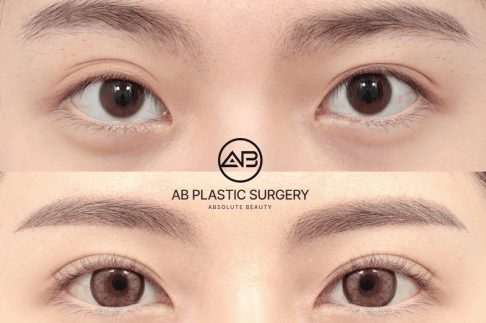 Uneven Eyes: 5 Common Causes and the Most Effective Ways to Correct Them