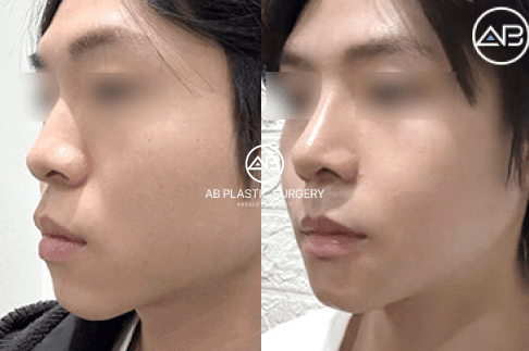 Upturned Nose: A Charming Feature or a Shape That Needs Correction?