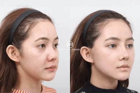 Ozempic Face Explained: Why Rapid Weight Loss Ages the Face and How Doctors Treat It