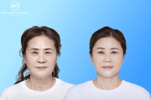 Choosing Between Upper and Lower Blepharoplasty in Korea – Expert Explanation for Natural Results