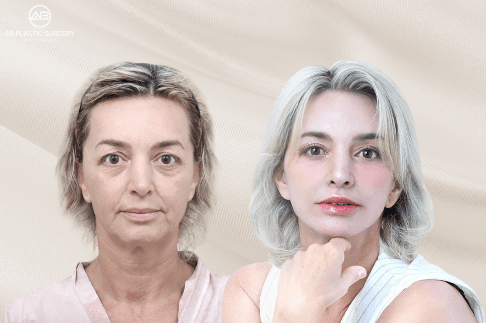 Are There Effective Treatments for Skin Laxity? Medical Options Explained