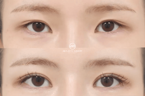 Epicanthoplasty in Korea: Purpose, Procedure, and Who It Is For