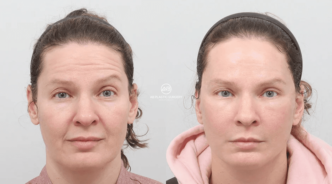 Deep Plane Facelift Korea: Structural Rejuvenation, Longevity, and Institutional Safety Standards