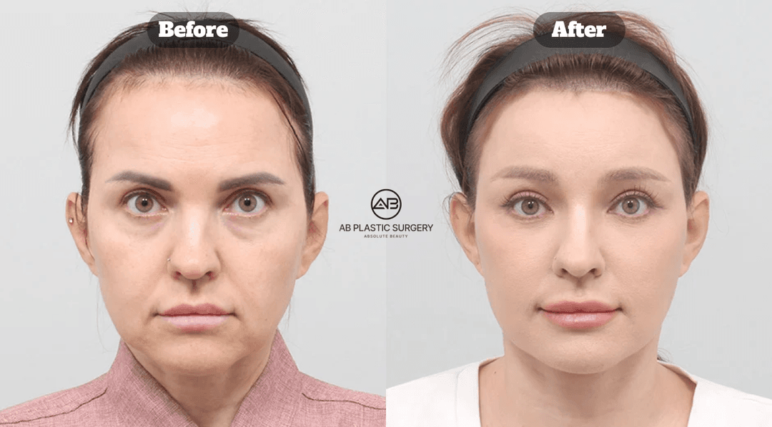 Facelift Surgery in Korea: Minimal Scars, Maximum Lift with the AB Plastic Surgery Method
