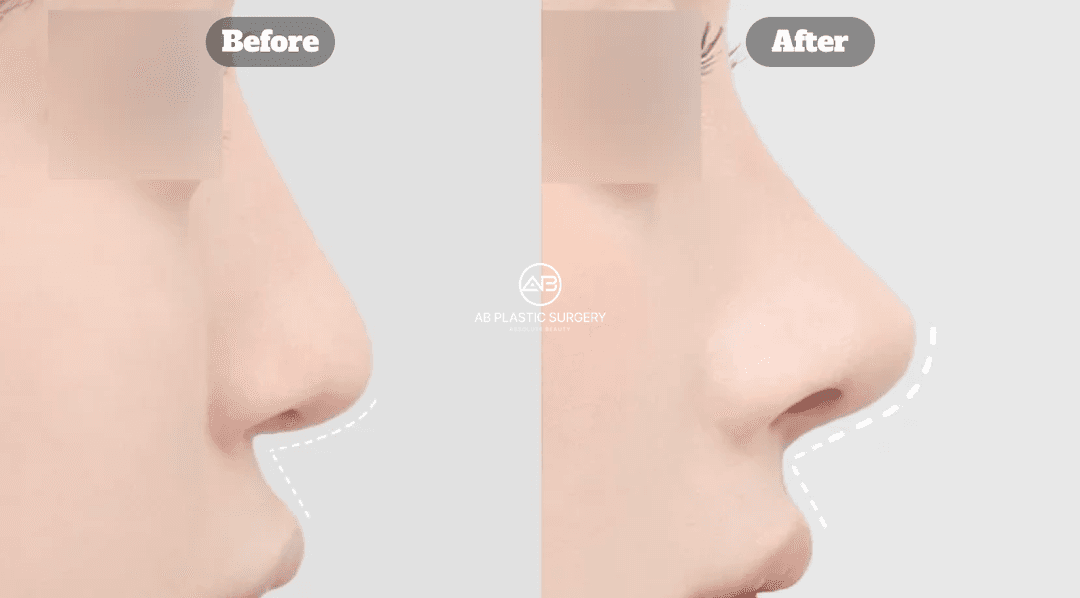 Korean Nose Job Before and After: Structural Differences by Nose Type and Why They Matter