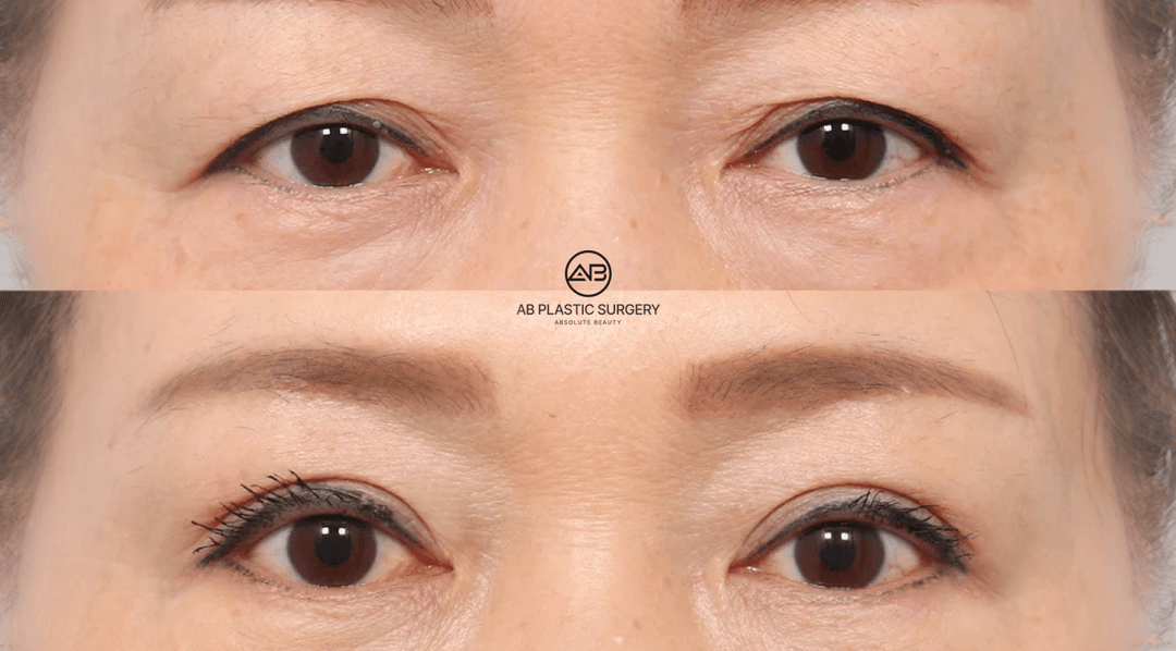 Ptosis Correction in Korea: 7 Things You Must Know Before Eyelid Surgery