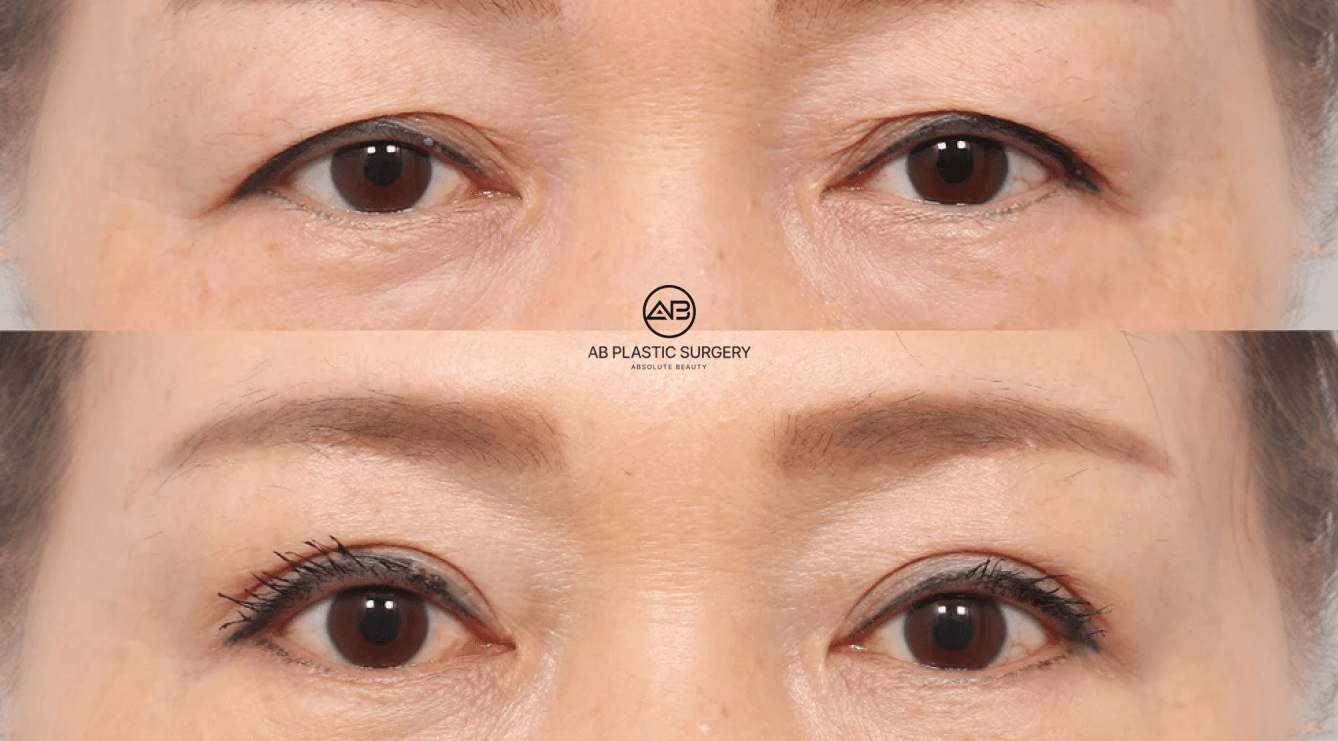 Ptosis Correction in Korea: 7 Things You Must Know Before Eyelid Surgery