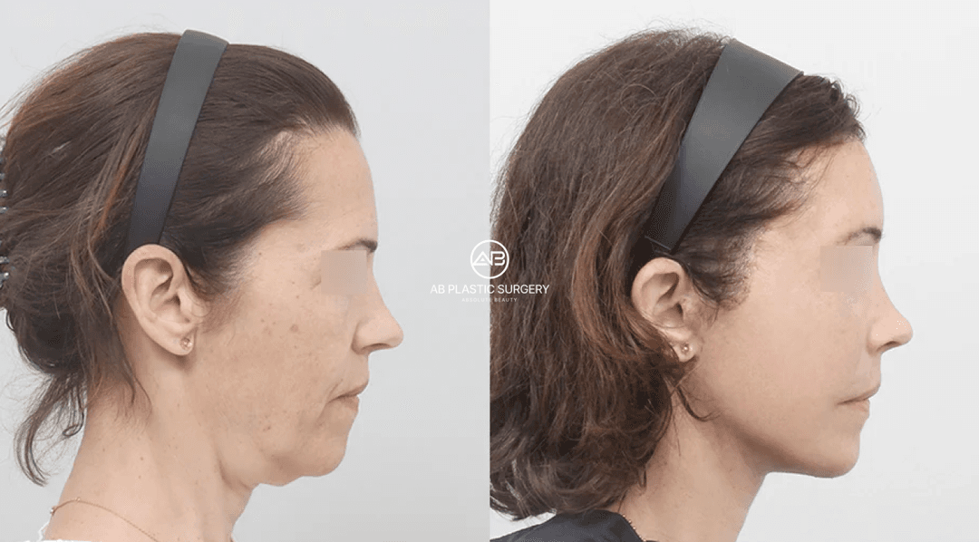 How to Get Rid of a Double Chin: Why Your Jawline Isn’t Defined and When to Consider Neck Lifting