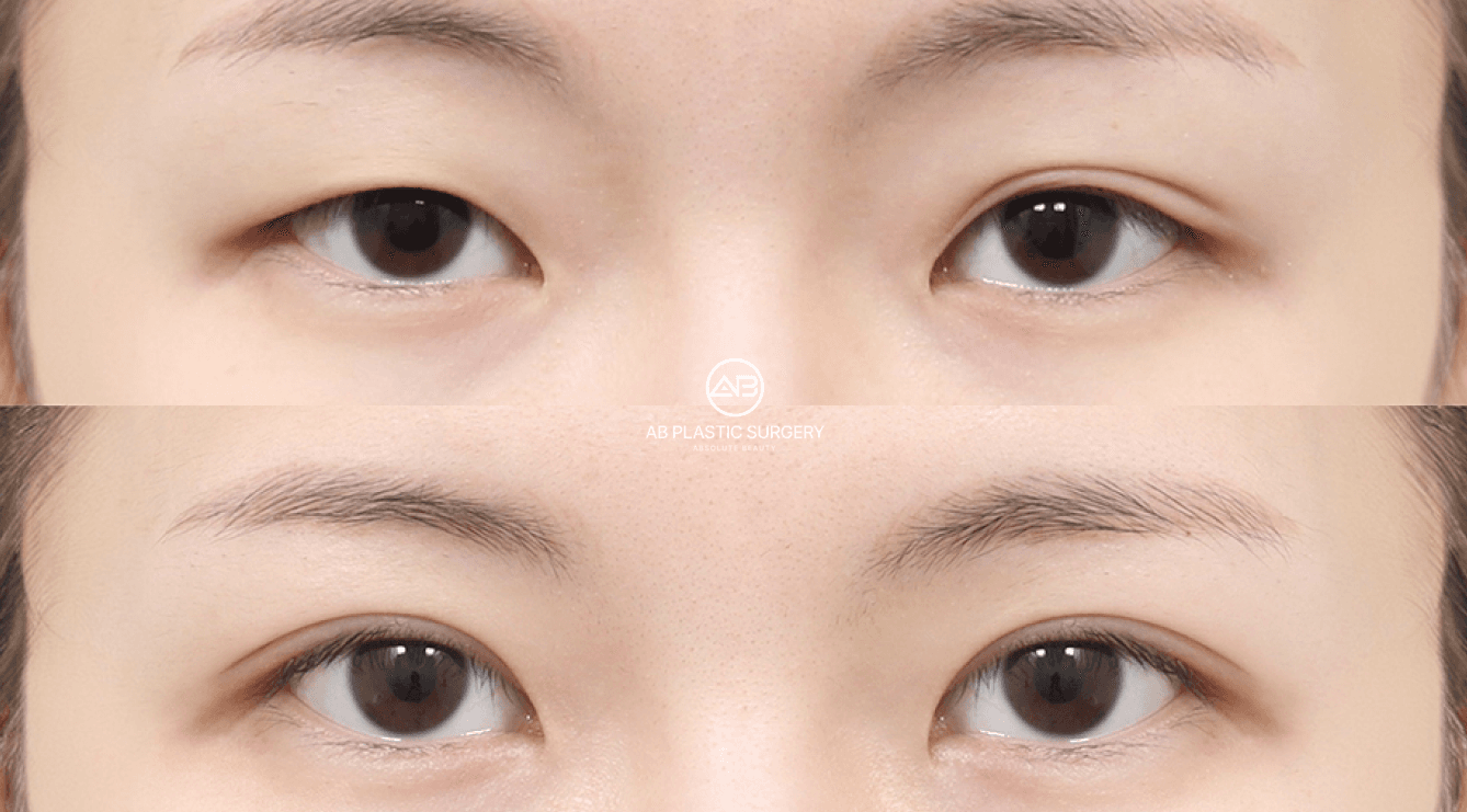 Korean Eyes vs Angel Eyes Surgery: What International Patients Should Know