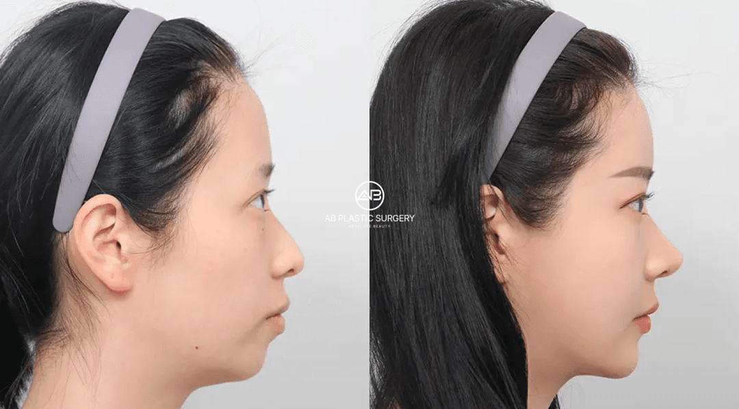 What Is Fat Grafting? A Complete Guide to Natural Volume Restoration