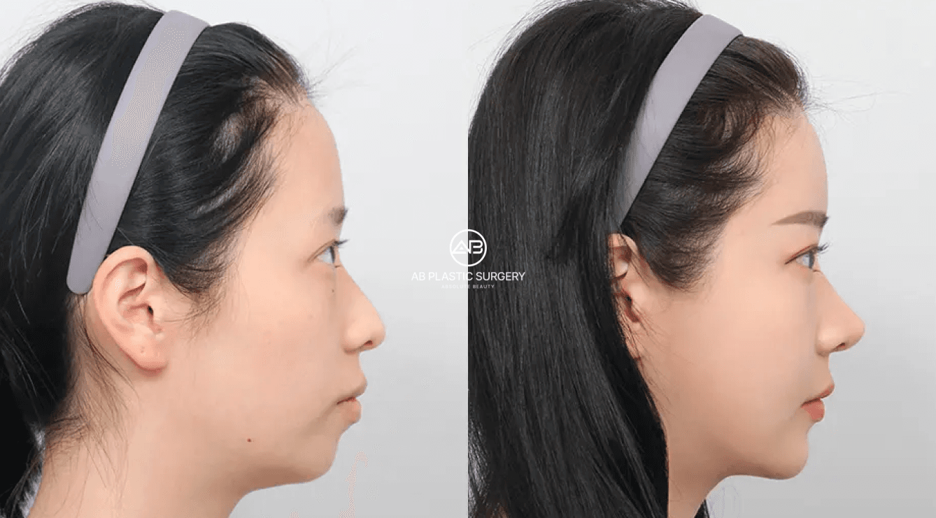 What Is Fat Grafting? A Complete Guide to Natural Volume Restoration