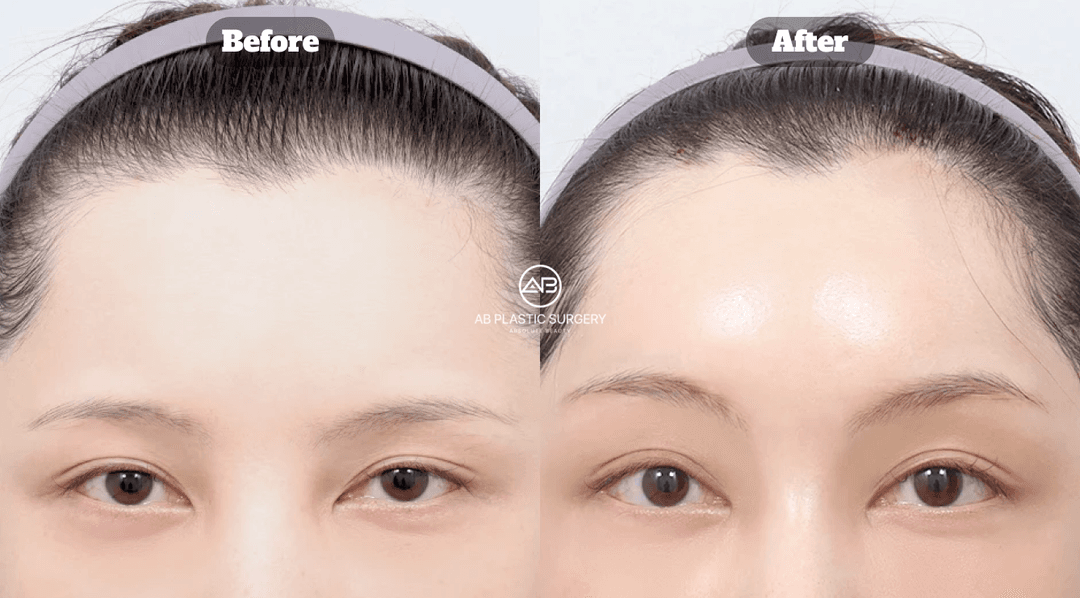 Endotine Brow Lift vs Botox Brow Lift: What's the Difference?