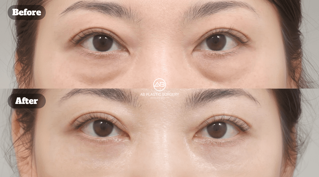 Tired Eyes Making You Look Older? Lower Blepharoplasty in Korea