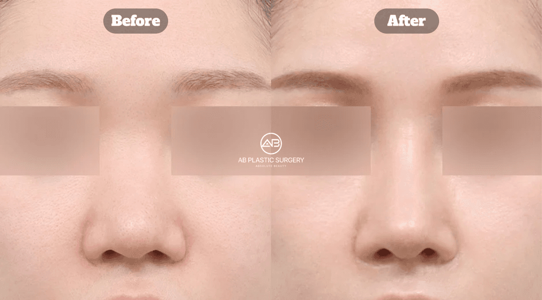 Unsatisfied with Your Nose Surgery? Revision Rhinoplasty Guide in Korea