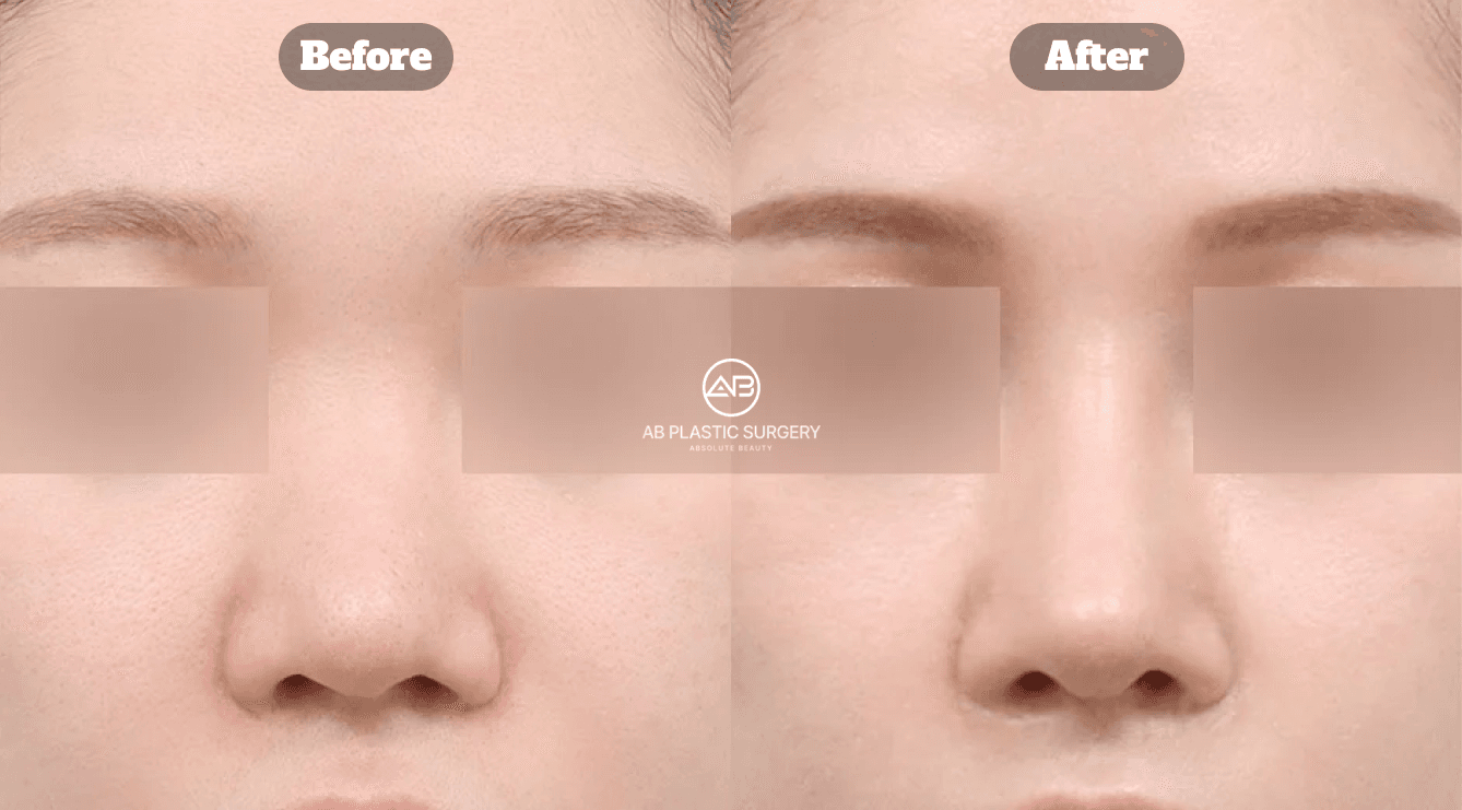 Unsatisfied with Your Nose Surgery? Revision Rhinoplasty Guide in Korea