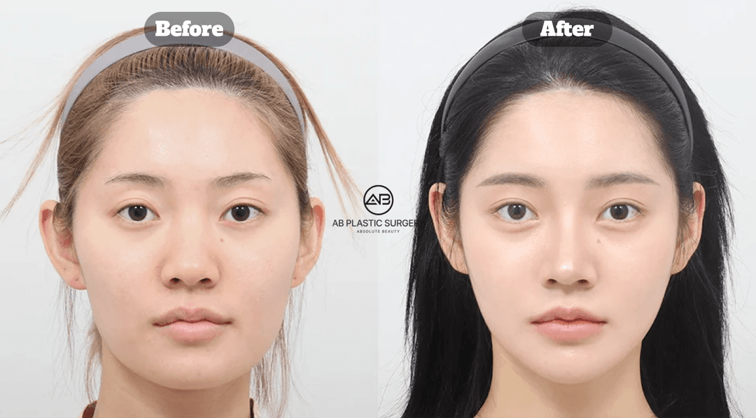 Genioplasty (Chin Tip Surgery) Explained, from Methods to Cost