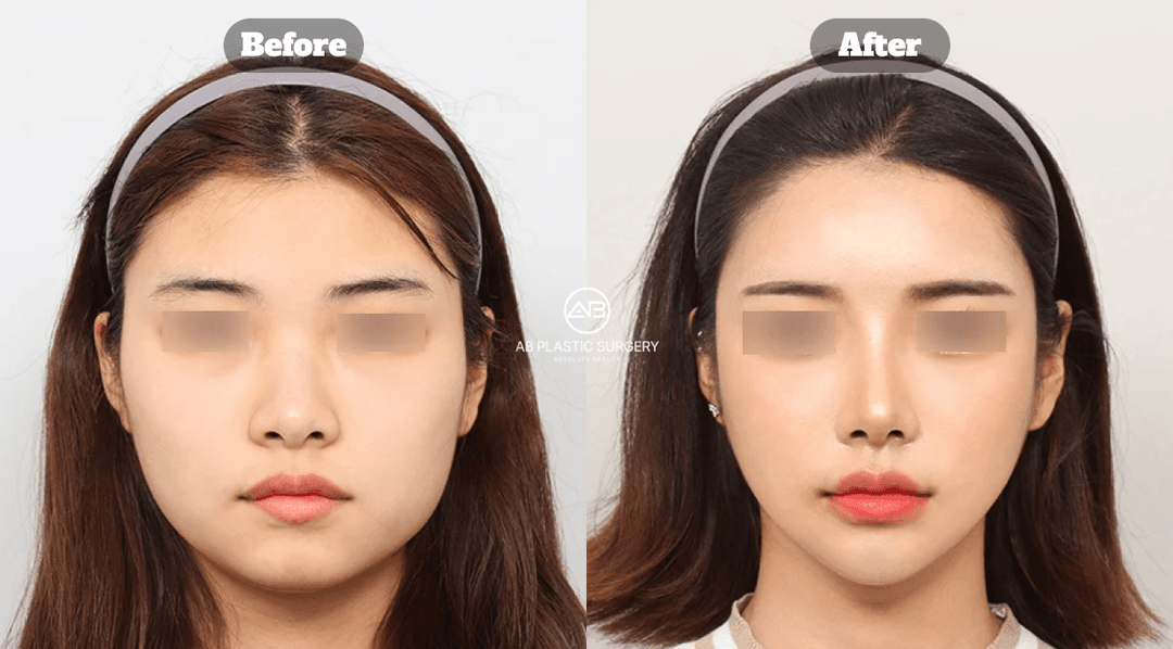 Under-Eye Fat Repositioning vs. Fat Removal: Which Is Better?