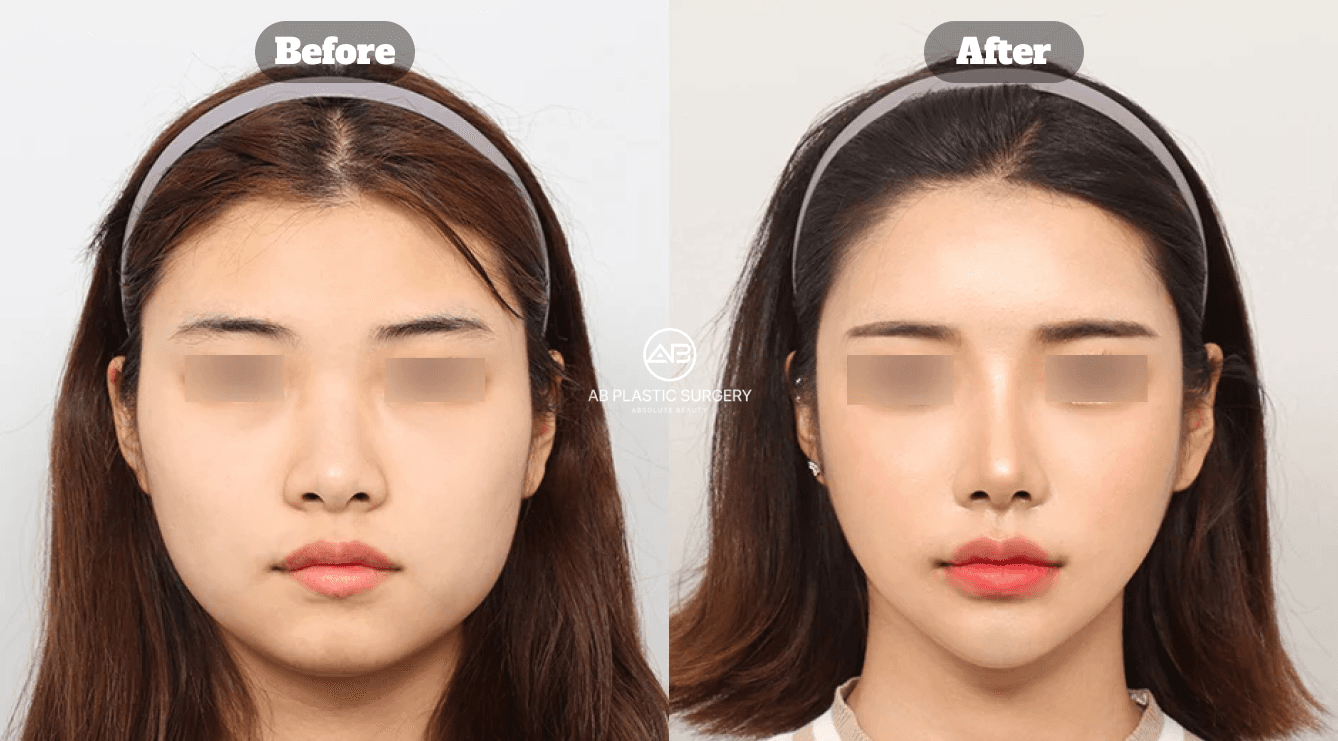 Under-Eye Fat Repositioning vs. Fat Removal: Which Is Better?