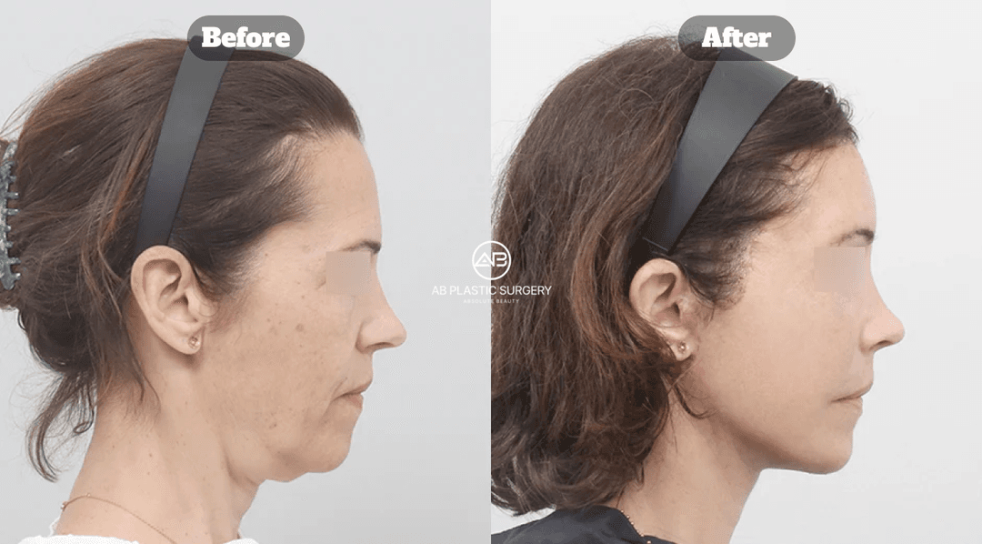 Neck Lift vs. Facelift: Which Procedure Is Right for You?