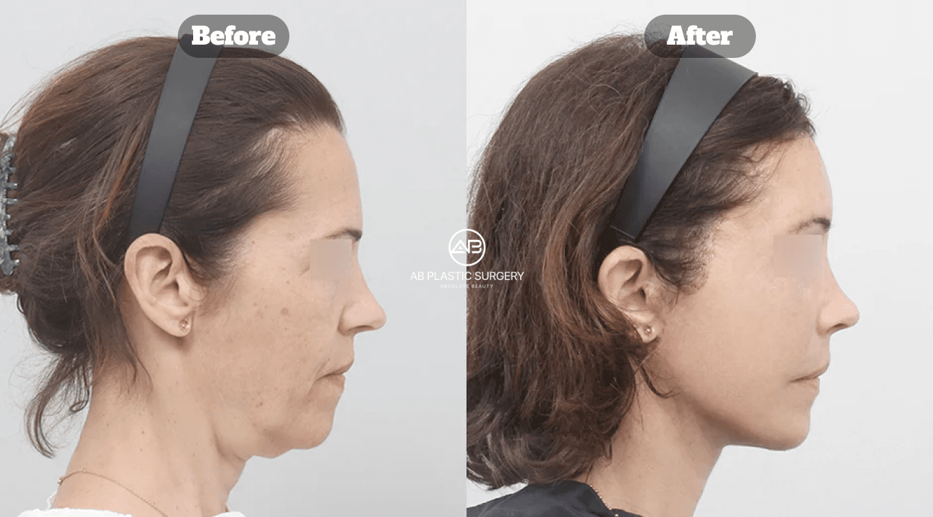 Neck Lift vs. Facelift: Which Procedure Is Right for You?