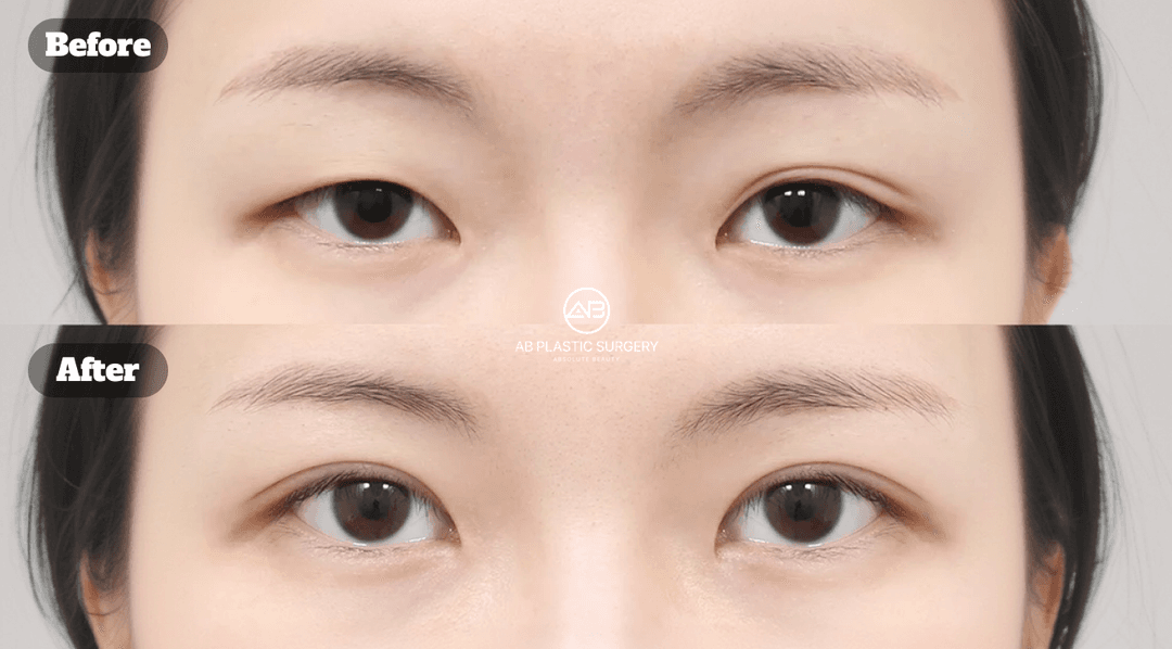 Revision Double Eyelid Surgery: Timing, What Gets Corrected, and What to Expect