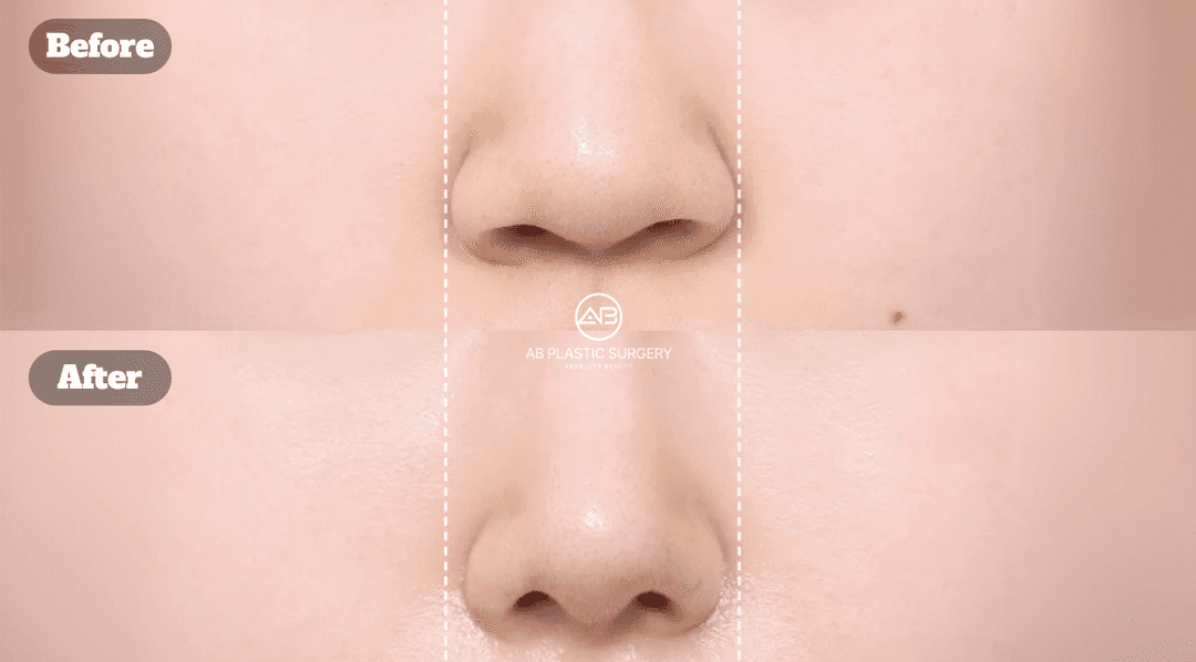 Alarplasty in Korea: How Alar Base Reduction Can Enhance Your Nose Shape