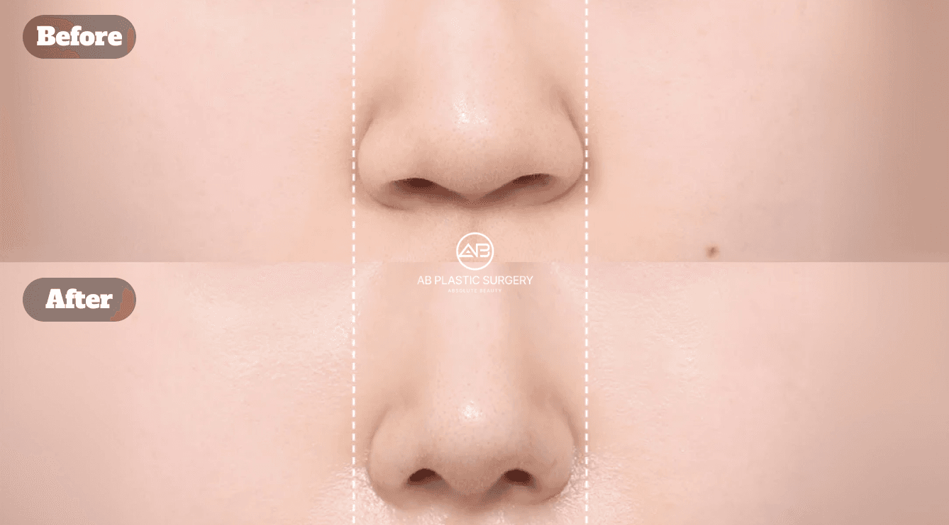 Alarplasty in Korea: How Alar Base Reduction Can Enhance Your Nose Shape