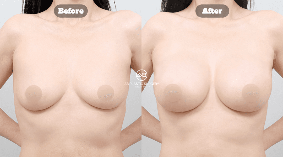 Breast Reduction Surgery: Designing a Balanced Shape for Your Body