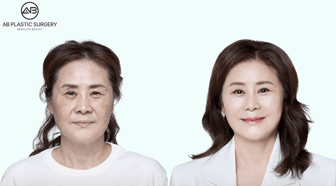 Droopy Eyelid Surgery: Upper Blepharoplasty vs Ptosis Correction