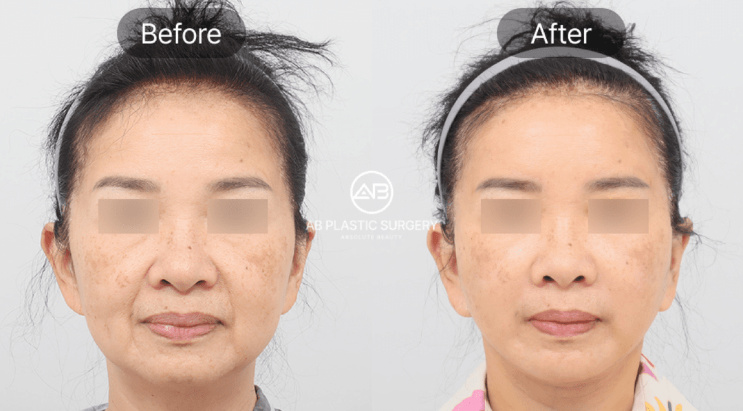 Face Liposuction vs Facial Fat Grafting: Where to Remove or Add Volume
