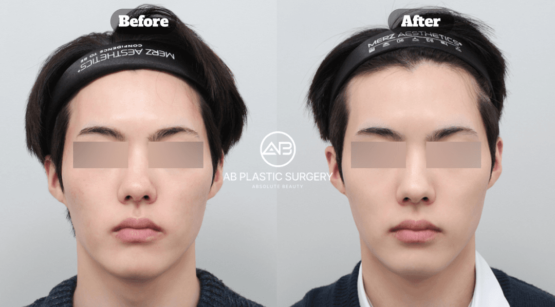 Laser Toning in Korea: How It Works, Results, and What to Expect