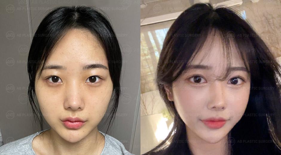 I'm glad I chose AB for my <Non-Incisional Ptosis Correction Reoperation, Epicanthoplasty, Lower Lateral Canthoplasty, Lateral Canthoplasty>. Got a pretty and big eyes now!