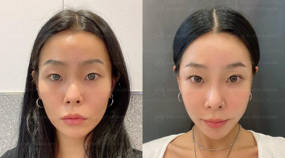 I had zygoma reduction surgery, rhinoplasty, and under-eye fat repositioning with facial fat grafting!