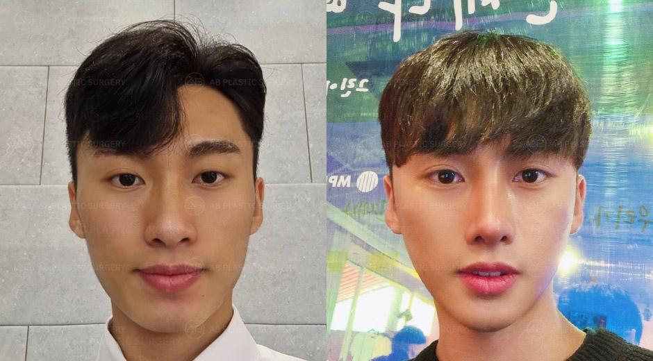 I am now so satisfied that I have no more complexes about my appearance. My nose surgery turned out incredibly well, and now my acquaintances keep asking me which plastic surgery clinic I went to. Haha!