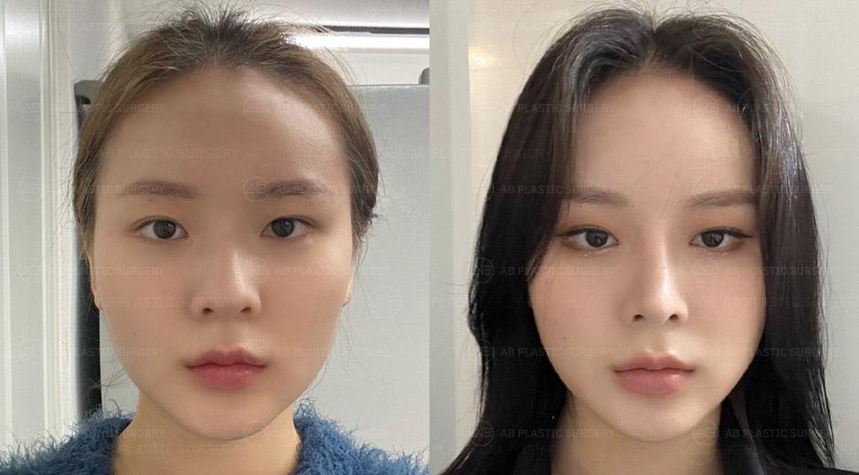 I am so happy with the beautiful cosmetic surgery that fits well with my facial proportions.